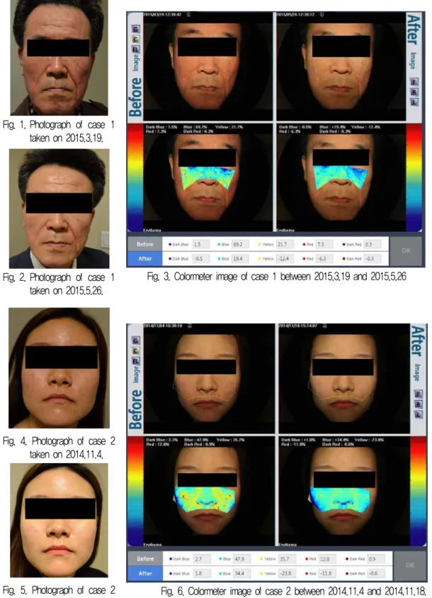 Fig. 3. Colormeter image of case 1 between 2015.3.19 and 2015.5.26 Fig. 2. Photograph  of  case  1 