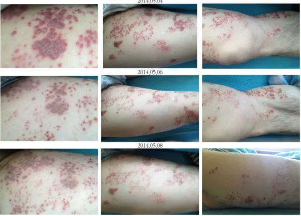 Fig. 2. The changes of skin herpes treated  with Yongdamsagan-tang