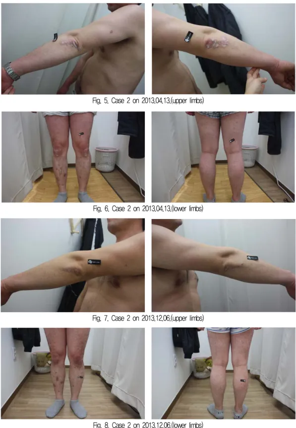 Fig. 5. Case 2 on 2013.04.13.(upper limbs)