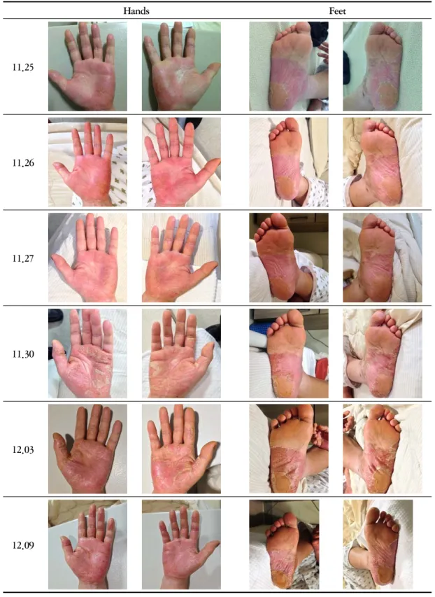 Fig. 1. The pictures of psoriasis on both hands and feet
