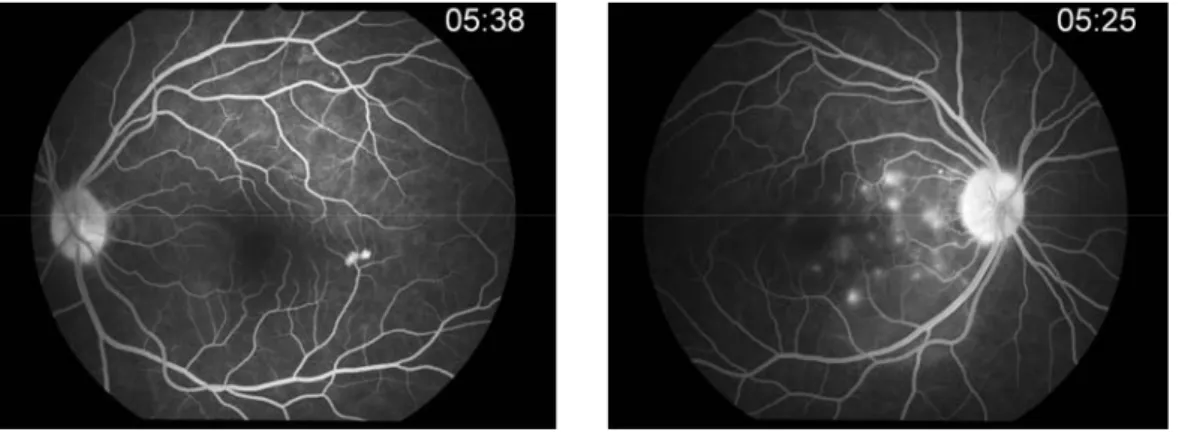 Fig. 4. Fluorescein angiography(FAG) before pulse steroid treatment(Lt/Rt)   