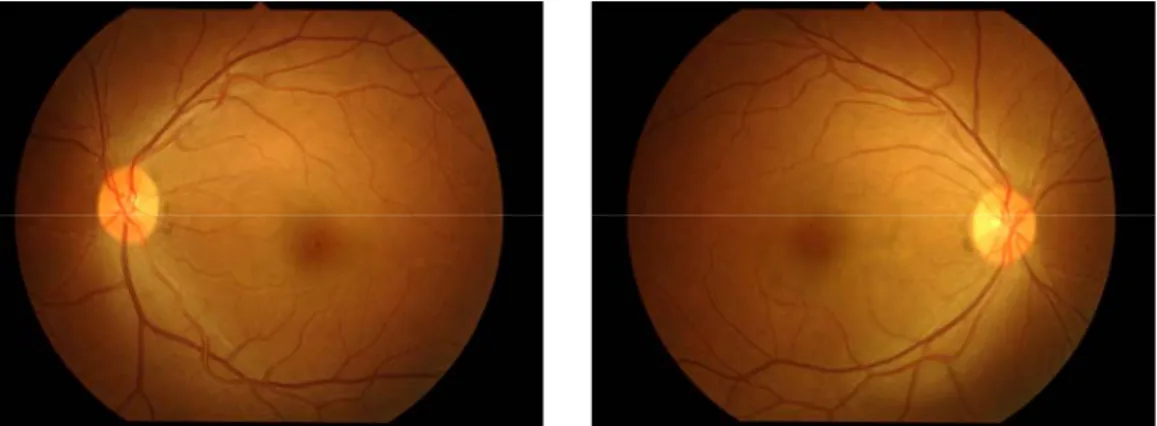 Fig. 5. Fundus photography after pulse steroid treatment(Lt/Rt)   