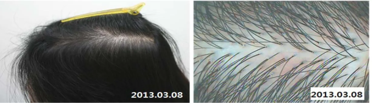 Fig. 5. When the treatment was finished, the AA patch on left temporal region was filled with a lot of normal hair.
