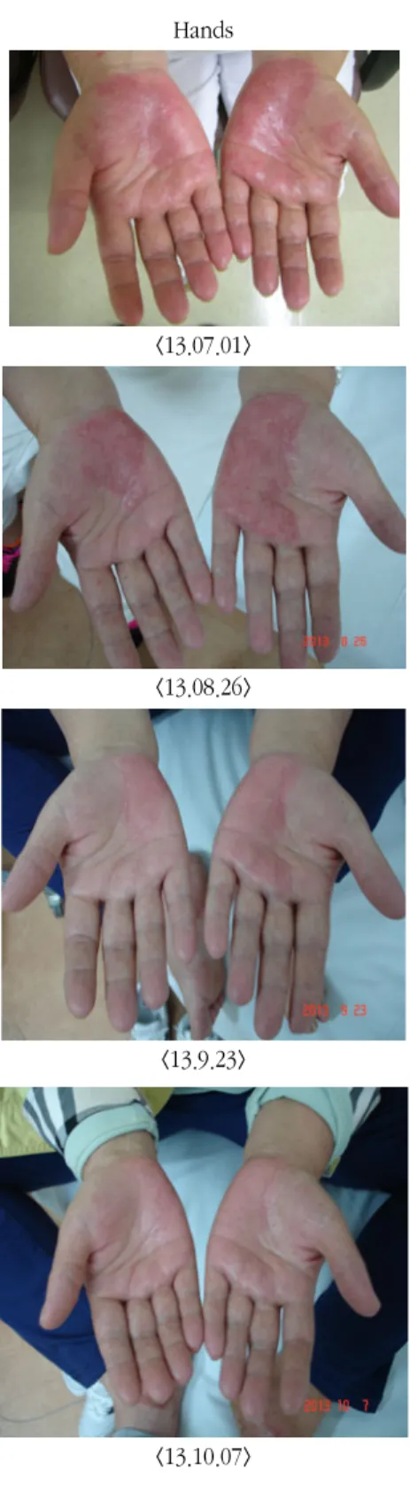 Fig.  1.  Pictures  of  psoriasis  on  both  hands  and  feet