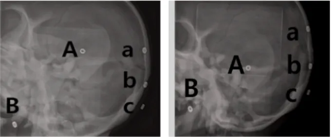 Fig.  4.  Image  with  metal  material  attached (a) Image of conventional method  (b) image using assistive devices