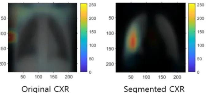 Fig. 9. Mean class activation mapping of the original CXR and  segmented  CXR(Normal  class)  –  Original  CXR  shows  high  activation  on  the  background  letter,