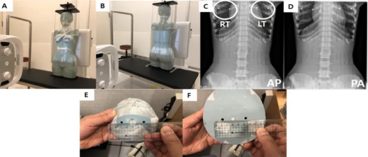 Fig. 1. This is experimental process. ‘A’ and ‘B’ were abdomen AP and PA projection position