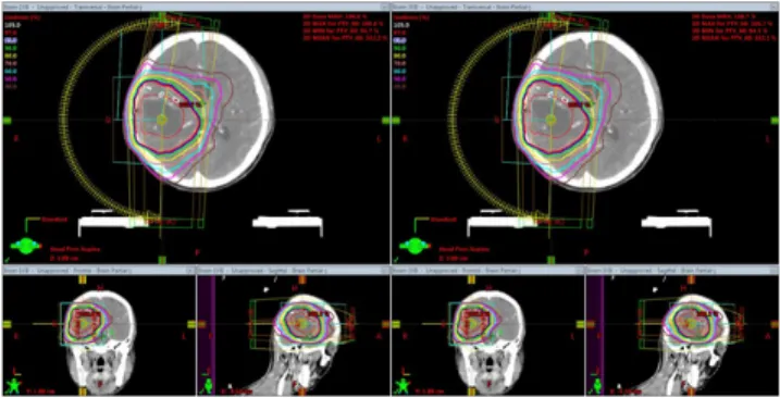 Fig. 4.  Comparison  of  the  dose  volume  histograms(DVHs)  in  brain volumetric modulated arc therapy(VMAT) plans of  any  patient  for  beam-matched  Linacs