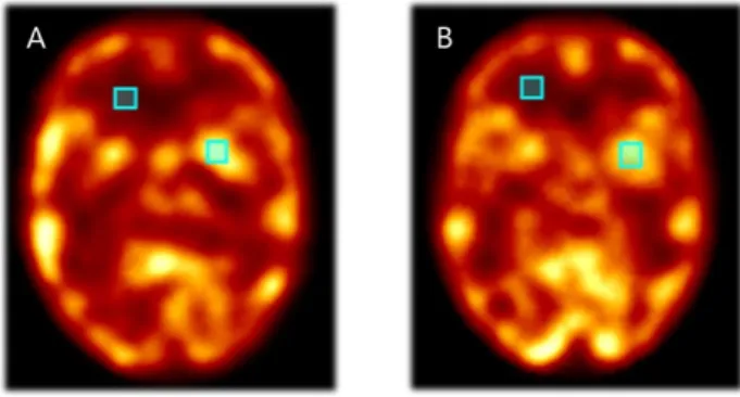Fig.  7.  Setting  the  ROI  of  white  and  gray  matter  in  the  examination  of  the  conventional  phantom(A)  and  3D  printing  based  phantom(B)