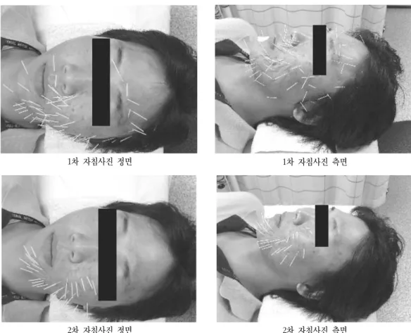 Fig.  1.  Picturure  of  acupuncture  treatment