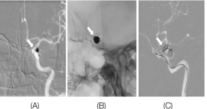 Fig. 2. Cerebral aneurysm size measurement. width, depth(A), neck(B).