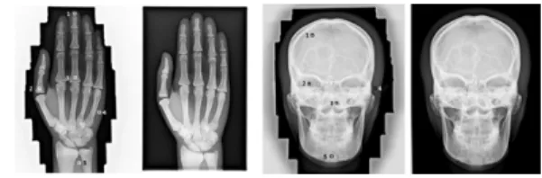 Fig.  3.  ROI  settings  on  radiographs  of  hands  and  skull  with  MLC  and  ARC.