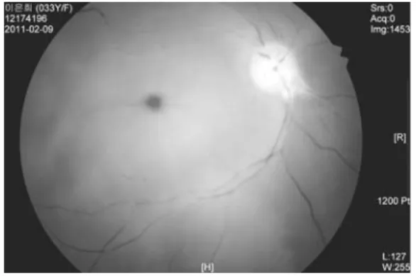 Fig.  1.  Ophthamoscopy(2011-02-09)