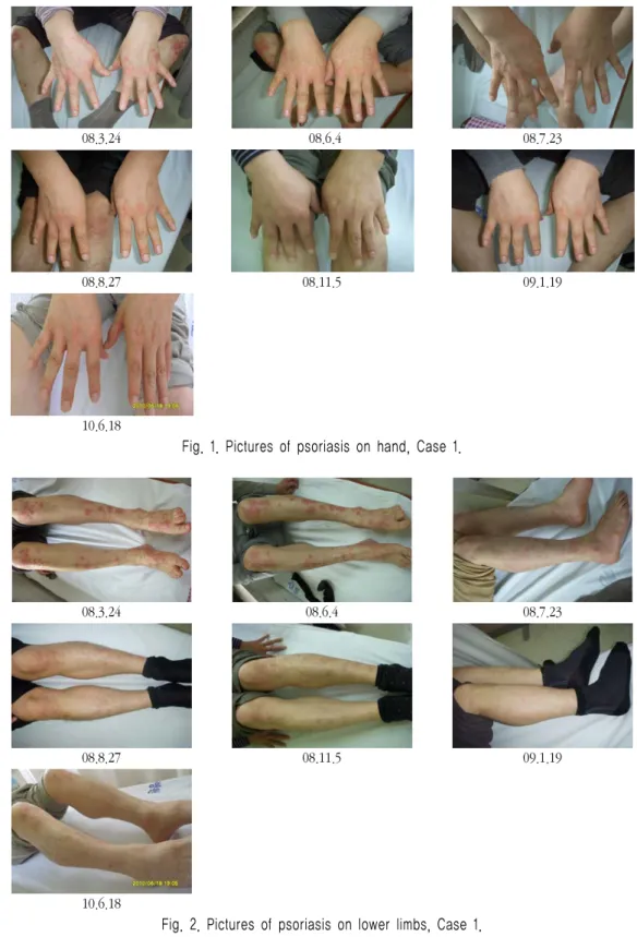 Fig. 2. Pictures of psoriasis on lower limbs, Case 1.