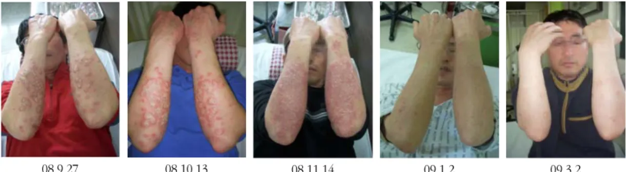 Fig. 5. Pictures of psoriasis on lower limbs, Case 2.