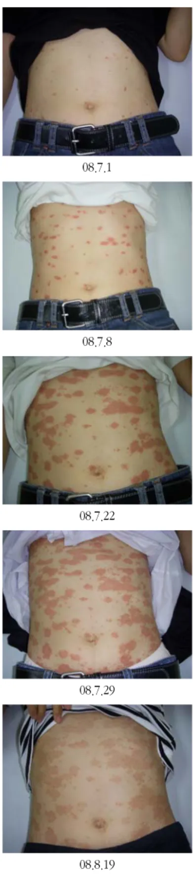 Fig. 9. Change of PASI score, Case 3. 