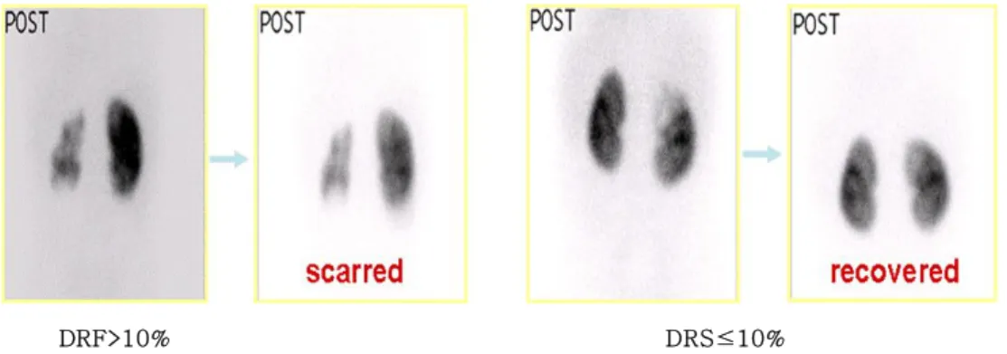 Fig. 1. Examples of 99m Tc-DMSA scan on recovered vs scarred kidneys, comparing the initial and the follow-up scans