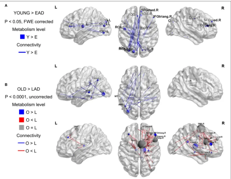 FIGURE 2 | Metabolic connectivity differences between the Alzheimer’s disease (AD) and control groups
