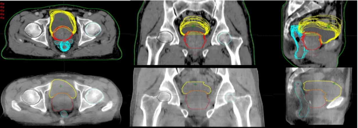 Fig.  1  Patient  organ  contouring  for  pCT  and  CBCT  (Prostate,  Bladder  and  Rectum)
