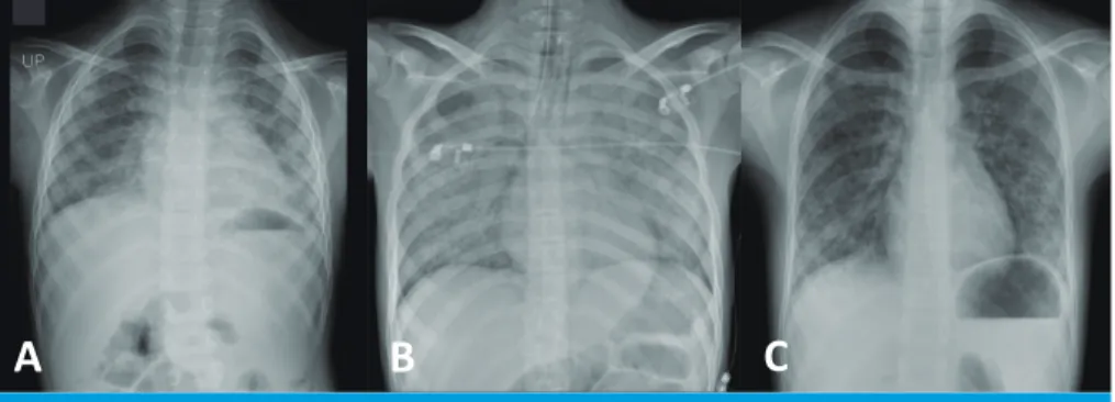 Fig. 1. Chest radiography. Chest radiography of (A) the first patient showing bilateral haziness of  lung fields, (B) the second patient showing diffuse ground glass opacities of both lungs, and (C)  the third patient showing patchy ground glass opacities 