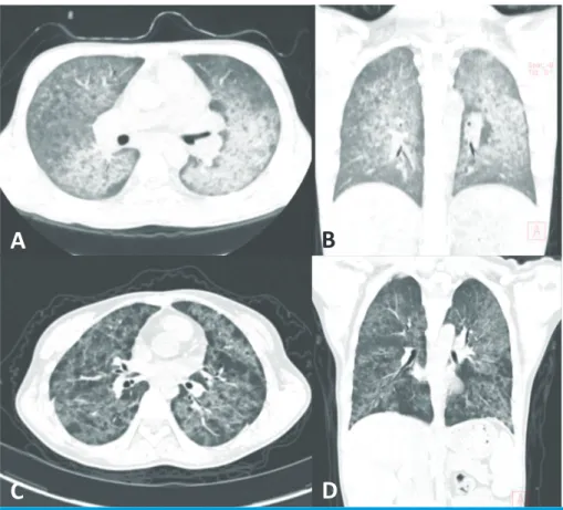 Fig. 2. Computed tomography (CT). (A) and (B): chest CT of the second patient shows diffuse  ground glass opacities of both lungs