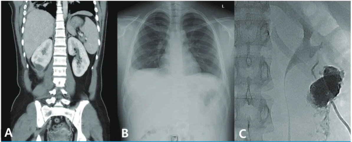 Fig. 1. Imaging studies demonstrating a ruptured right renal abscess with peritonitis, pleural effusion and catheter  drainage of the abscess
