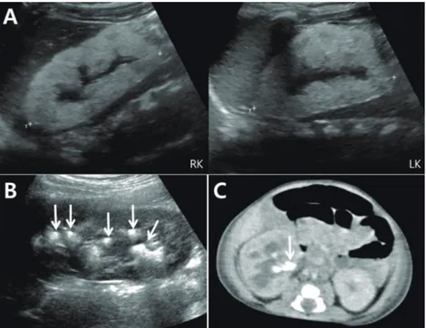 Fig. 1. Imaging studies in patients with primary hyperoxaluria. (A) Kidney ultrasonography  shows diffuse increased echogenicity indicating nephrocalcinosis and loss of  corticome-dullary differentiation of both kidneys in patient 1