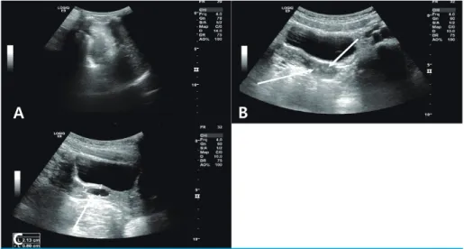 Fig 1. Ultrasonography scan of a 7-year-old girl on August 2017, demonstrating the absence of  the left kidney (A) and separated vaginal canal (B)