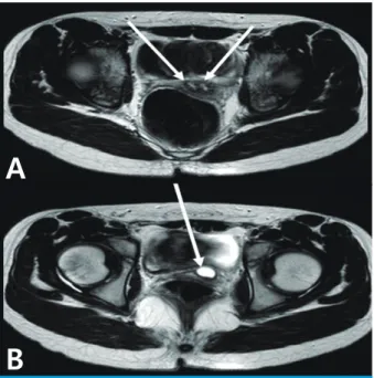 Fig. 2. Magnetic resonance imaging (T2-weighted image) scans  suggesting Herlyn-Werner-Wunderlich syndrome