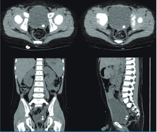 Fig. 2. Computed tomography image shows 0.7cm sized hyperdense lesions in bladder. 