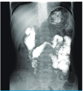 Fig. 2. Abdomen &amp; pelvis CT (enhancement). (A) LRV was compressed by the aorta and the supe- supe-rior mesenteric artery (aorto-SMA distance: 4.6 mm)