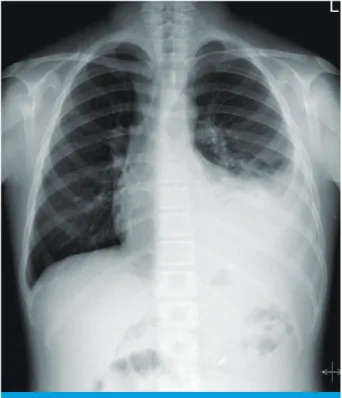Fig. 1. Initial chest postero-anterior view. There is a large amount  of left pleural effusion with passive atelectasis of the left lower  lung field