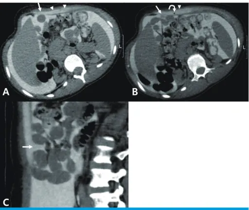 Fig. 3. Computed tomography peritoneography after 1 hour of injecting a water-soluble iodinated  contrast media in an oblique prone position