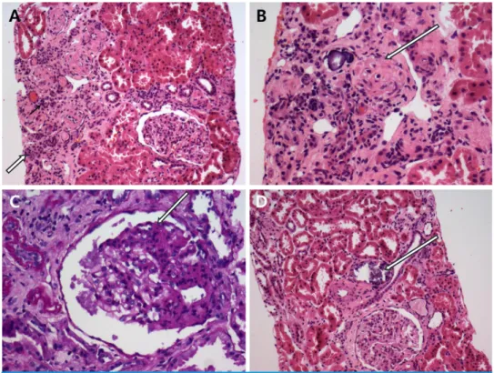Fig. 1. A portion of dysplastic area is present separated by normal cortical areas. In dys plastic area,  immature tubules (arrows) and aggregates of small globally sclerotic glo meruli are shown (H&amp;E, x10, A)