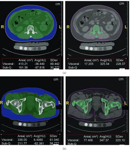 Figure 1: Screenshots of the semiautomatic calculation software (FatScan, N2 systems): (a) at the L2 level, the circumferences of the body and cross-sectional area of bone are segmented; and (b) at the hip level, the circumferences of the body and cross-se