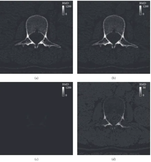 Figure 5: BMD contour plot at the axial level of the L2 vertebra: (a) the reference BMD using an external phantom, (b) BMD estimated using the proposed phantomless HU-to-BMD conversion, (c) a deviation between the reference and estimated BMD values, and (d