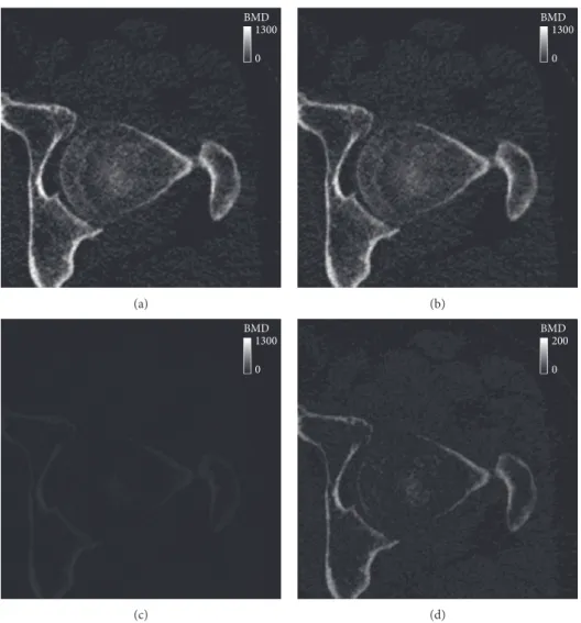 Figure 6: BMD contour plot at the axial level of the hip joint: (a) the reference BMD using an external phantom, (b) BMD estimated using the proposed phantomless HU-to-BMD conversion, (c) a deviation between the reference and estimated BMD values, and (d) 