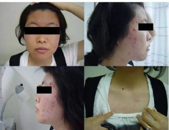 Table 4. Korean Acne Grading system (KAGS) 6) Grade Description 1 2 3 4 5 6   papules  ≤  10   papules  11-30   papules  ≥  31,  nodules  ≤  10