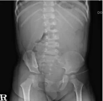 Fig. 1. Multiple palpable purpuric lesions on lower limbs. Both 