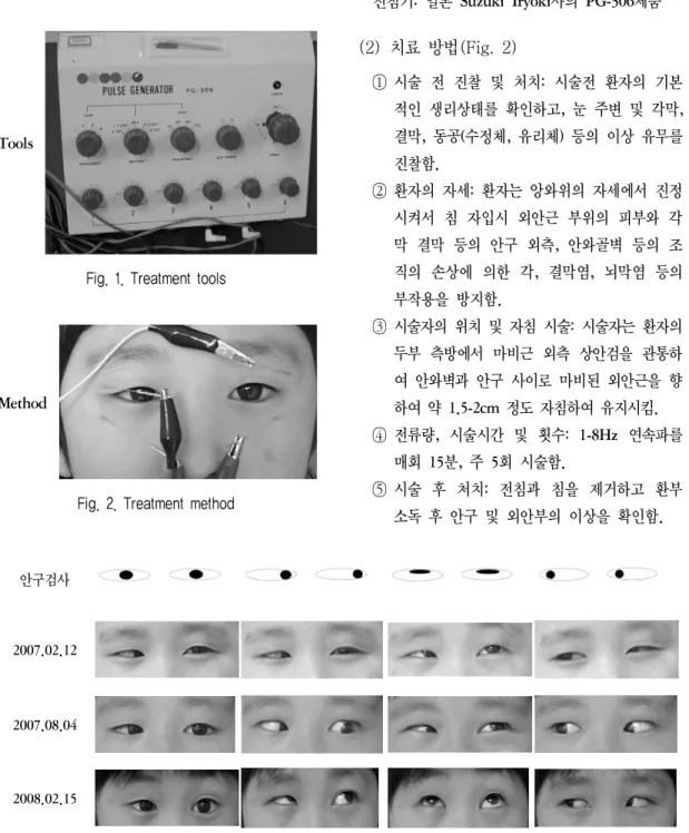 Fig. 1. Treatment tools