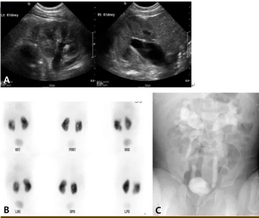 Fig. 1. (A) Bilateral hydronephrosis on renal sonogram. (B) Multiple cortical defects in the right  kidney with a normal relative renal uptake ratio on dimercaptosuccinic acid renal scan