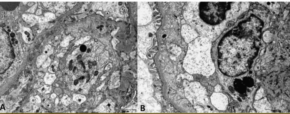 Fig. 4. Electron microscopic features of TMA ; The glomerular basement membrane presents  diffuse expansion of endothelial zone with deposition of electron lucent material