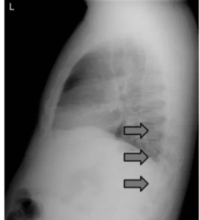 Figure  1  Ghost  Artifact  –  FPD  Detector