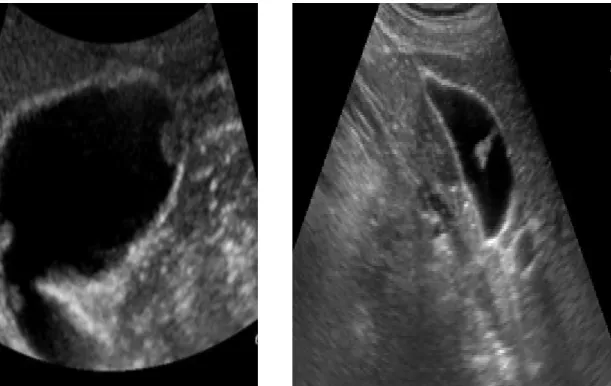 Figure  1  Ultrasound  imaging  of  the  gallbladder  polyp