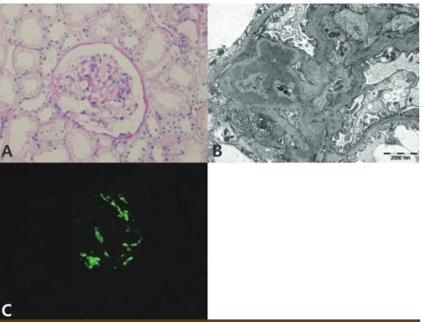 Fig. 1. (A) Light microscopy shows segmental sclerosis and synechia of capillary loop to  Bowman's capsule (PAS, ×400)