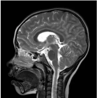 Fig. 1. Brain MRI (Sagittal plane) shows no evidence of abnormal lesion.