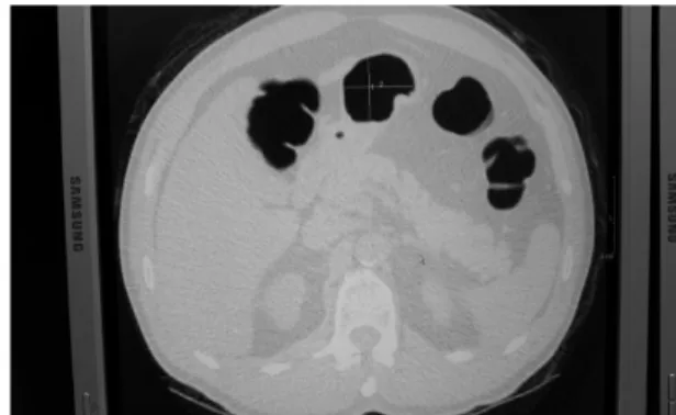Fig.  2  Aluminium  Spine  Phantom(ASP)
