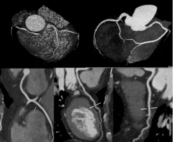 Fig.  1  Reconstruction  image  in  coronary  CTA