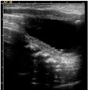 Fig. 1. A) MRI of pelvis shows right kidney agenesis and non visualization of uterus. B) MRI of pelvis shows right and left intact ovary and bladder.