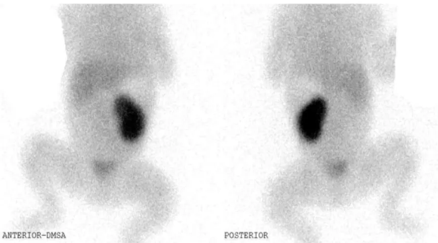 Fig. 3. DMSA scan shows nonvisualization of right kidney and no ectopic kidney. 장 무형성증과 자궁의 결손을 발견하였으며(Fig.1A, B) 입원 5일째 시행한 신장 초음파에서 질의 상부 1/3만 있음을 확인하였다(Fig